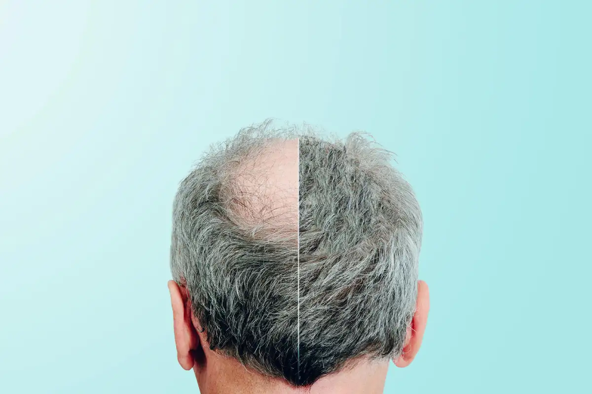 تاسی و ریزش مو