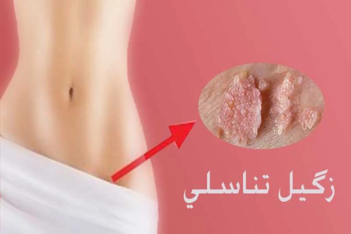 درمان سه سوته زگیل تناسلی